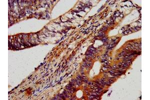 IHC image of ABIN7151284 diluted at 1:600 and staining in paraffin-embedded human colon cancer performed on a Leica BondTM system.