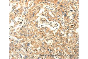 Immunohistochemistry of Human lung cancer using AGRN Polyclonal Antibody at dilution of 1:30 (AGRN 抗体)