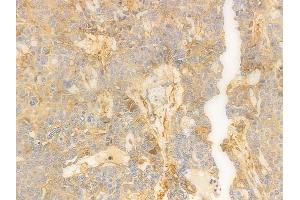 ABIN6259956 and ABIN6276843 at 1/100 staining human ovarian carcinoma by IHC-P.