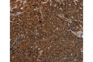 Immunohistochemistry of Human cervical cancer using KDM4B Polyclonal Antibody at dilution of 1:50 (KDM4B 抗体)
