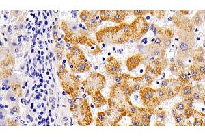 Detection of LAMP1 in Human liver cirrhosis Tissue using Polyclonal Antibody to Lysosomal Associated Membrane Protein 1 (LAMP1) (LAMP1 抗体  (AA 49-297))