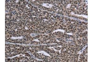 The image on the left is immunohistochemistry of paraffin-embedded Human ovarian cancer tissue using ABIN7191353(MAGEC1 Antibody) at dilution 1/30, on the right is treated with synthetic peptide. (MAGEC1 抗体)