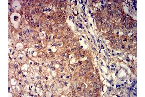 Immunohistochemical analysis of paraffin-embedded stomach cancer tissues using GRM3 mouse mAb with DAB staining. (Metabotropic Glutamate Receptor 3 抗体  (AA 433-576))