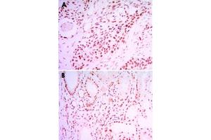 Immunohistochemical analysis of paraffin-embedded human lung cancer tissue (A) and kidney cancer tissue (B) using SIRT1 monoclonal antobody, clone 1F3  with DAB staining. (SIRT1 抗体)