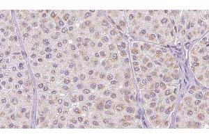 ABIN6277784 at 1/100 staining Human melanoma tissue by IHC-P. (CCL2 抗体  (Internal Region))