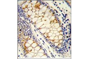Formalin-Fixed, Paraffin-Embedded Human colon carcinoma reacted with SFRS1 Antibody (C-term), which was Peroxidase-conjugated to the secondary antibody, followed by DAB staining. (SRSF1 抗体  (C-Term))