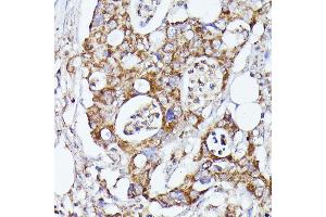 Immunohistochemistry of paraffin-embedded human colon carcinoma using CDK5R antibody (ABIN7266235) at dilution of 1:100 (40x lens).