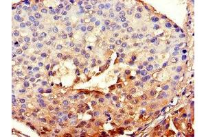 Immunohistochemistry of paraffin-embedded human breast cancer using ABIN7147837 at dilution of 1:100 (BHLHE40 抗体  (AA 184-302))