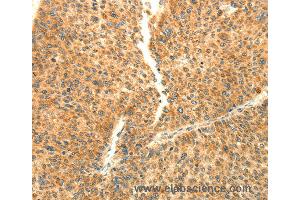 Immunohistochemistry of Human liver cancer using AARS2 Polyclonal Antibody at dilution of 1:80 (AARS2 抗体)