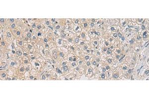 Immunohistochemistry of paraffin-embedded Human liver cancer tissue using WFDC3 Polyclonal Antibody at dilution of 1:40(x200) (WFDC3 抗体)