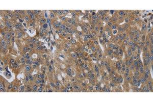 Immunohistochemistry of paraffin-embedded Human ovarian cancer using SOCS1 Polyclonal Antibody at dilution of 1:90 (SOCS1 抗体)