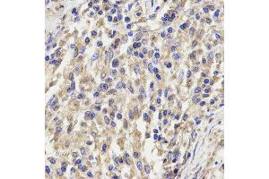 Immunohistochemistry of paraffin-embedded human lung cancer using KLRD1 antibody at dilution of 1:200 (x400 lens) (CD94 抗体)