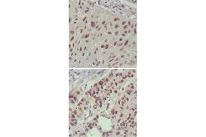 Immunohistochemical analysis of paraffin-embedded human lung cancer (upper) and cervical carcinoma (bottom) , showing nuclear localization using ISL1 monoclonal antibody, clone 1H9  with DAB staining. (ISL1 抗体)