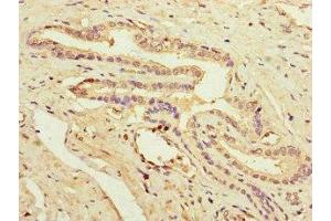 Immunohistochemistry of paraffin-embedded human prostate cancer using ABIN7162936 at dilution of 1:100 (Peroxiredoxin 2 抗体  (AA 2-65))
