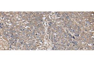 Immunohistochemistry of paraffin-embedded Human liver cancer tissue using ZFP36 Polyclonal Antibody at dilution of 1:40(x200) (ZFP36 抗体)