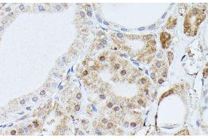 Immunohistochemistry of paraffin-embedded Human thyroid cancer using PPP2R5D Polyclonal Antibody at dilution of 1:100 (40x lens). (PPP2R5D 抗体)