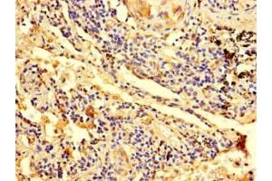 Immunohistochemistry of paraffin-embedded human lung cancer using ABIN7176377 at dilution of 1:100 (ZNF559 抗体  (AA 1-300))