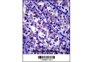 LAMB1 Antibody immunohistochemistry analysis in formalin fixed and paraffin embedded human kidney carcinoma followed by peroxidase conjugation of the secondary antibody and DAB staining. (Laminin beta 1 抗体  (C-Term))