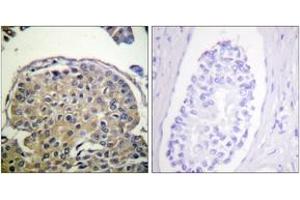 Immunohistochemistry analysis of paraffin-embedded human breast carcinoma, using CD227/Mucin 1 (Phospho-Tyr1243) Antibody. (MUC1 抗体  (pTyr1243))