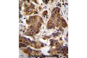 C4orf21 Antibody (N-term) immunohistochemistry analysis in formalin fixed and paraffin embedded human bladder carcinoma followed by peroxidase conjugation of the secondary antibody and DAB staining. (ZGRF1 抗体  (N-Term))