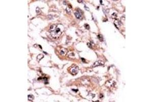Formalin-fixed and paraffin-embedded human cancer tissue reacted with the primary antibody, which was peroxidase-conjugated to the secondary antibody, followed by AEC staining.