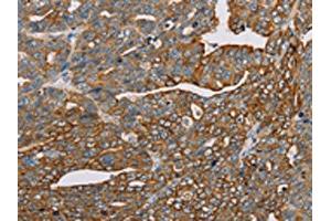 The image on the left is immunohistochemistry of paraffin-embedded Human cervical cancer tissue using ABIN7130290(MTFP1 Antibody) at dilution 1/30, on the right is treated with fusion protein. (Mtfp1 抗体)