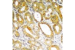 Immunohistochemical analysis of PDK4 staining in human colon cancer formalin fixed paraffin embedded tissue section. (PDK4 抗体)