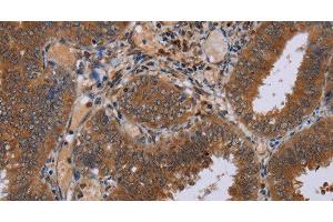 Immunohistochemistry of paraffin-embedded Human colon cancer tissue using NPTX1 Polyclonal Antibody at dilution 1:50 (NPX1 抗体)