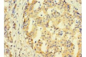 Immunohistochemistry of paraffin-embedded human pancreatic cancer using ABIN7171165 at dilution of 1:100 (SYTL3 抗体  (AA 1-300))