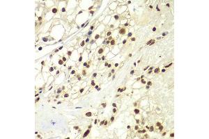 Immunohistochemistry of paraffin-embedded human kidney cancer using RPA2 Antibody. (RPA2 抗体  (AA 80-270))