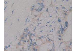 Detection of IGF1 in Human Bile duct cancer Tissue using Polyclonal Antibody to Insulin Like Growth Factor 1 (IGF1) (IGF1 抗体  (AA 49-118))