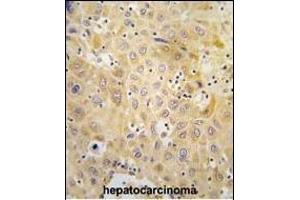 Formalin-fixed and paraffin-embedded human hepatocarcinoma tissue reacted with Autophagy G7L Antibody (N-term) 1813a , which was peroxidase-conjugated to the secondary antibody, followed by DAB staining. (ATG7 抗体  (N-Term))