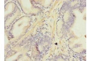 Immunohistochemistry of paraffin-embedded human prostate cancer using ABIN7160892 at dilution of 1:100 (NDUFA13 抗体  (AA 52-144))