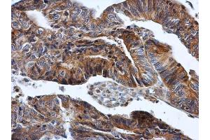 IHC-P Image HPRT antibody detects HPRT protein at cytoplasm in human colon cancer by immunohistochemical analysis. (HPRT1 抗体)