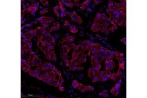 Immunofluorescence of paraffin embedded human breast cancer using Epl4 (ABIN7073843) at dilution of 1:2000 (300x lens) (EFNA4 抗体)