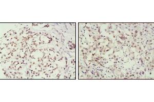 Immunohistochemical analysis of paraffin-embedded human breast cancer (left) and lung cancer (right) tissues, showing nuclear localization using MSH2 mouse mAb with DAB staining. (MSH2 抗体)