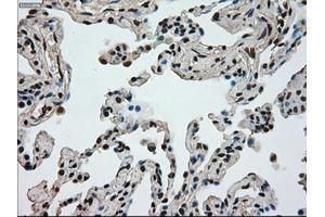 Immunohistochemical staining of paraffin-embedded Adenocarcinoma of breast tissue using anti-MKI67 mouse monoclonal antibody. (Ki-67 抗体  (AA 1-250))