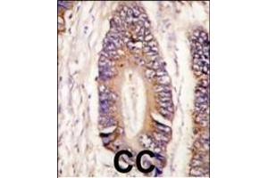 Formalin-fixed and paraffin-embedded human colon carcinoma tissue reacted with MLK4 antibody (N-term) (ABIN392542 and ABIN2842092) , which was peroxidase-conjugated to the secondary antibody, followed by DAB staining. (MLK4 抗体  (N-Term))
