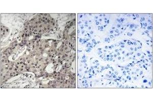 Immunohistochemistry analysis of paraffin-embedded human breast carcinoma tissue, using RPL3 Antibody. (RPL3 抗体  (AA 211-260))