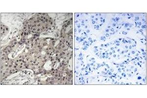 Immunohistochemistry analysis of paraffin-embedded human breast carcinoma tissue, using RPL3 Antibody. (RPL3 抗体  (AA 211-260))