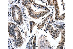 Immunohistochemistry of Human colon cancer using KLK7 Polyclonal Antibody at dilution of 1:10 (Kallikrein 7 抗体)