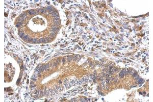 IHC-P Image OFD1 antibody detects OFD1 protein at cytosol on human gastric cancer by immunohistochemical analysis. (OFD1 抗体  (Center))