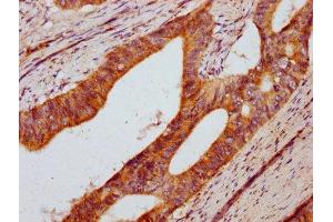 IHC image of ABIN7150742 diluted at 1:400 and staining in paraffin-embedded human colon cancer performed on a Leica BondTM system. (DUSP13 抗体  (AA 1-198))