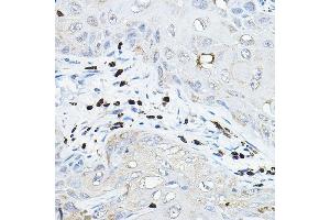 Immunohistochemistry of paraffin-embedded human esophageal cancer using NOX/p67phox Rabbit pAb (ABIN3021640, ABIN3021641, ABIN3021642, ABIN1513243 and ABIN6215468) at dilution of 1:100 (40x lens). (NCF2 抗体  (AA 227-526))