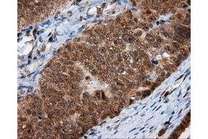 Immunohistochemical staining of paraffin-embedded Adenocarcinoma of colon tissue using anti-MTRF1L mouse monoclonal antibody. (MTRF1L 抗体)