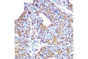 Immunohistochemistry of paraffin-embedded human colon carcinoma using HSP60/HSPD1 Rabbit mAb (ABIN1680746, ABIN3015220, ABIN3015221 and ABIN7101321) at dilution of 1:100 (40x lens).