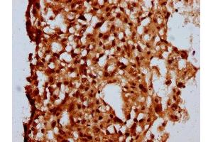 IHC image of ABIN7160108 diluted at 1:500 and staining in paraffin-embedded human melanoma performed on a Leica BondTM system. (MKL2 抗体  (AA 164-313))