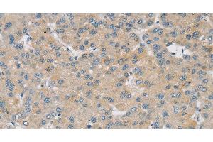 Immunohistochemistry of paraffin-embedded Human liver cancer using SMOC2 Polyclonal Antibody at dilution of 1:30