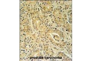 UBAC1 Antibody (C-term) (ABIN651546 and ABIN2840294) immunohistochemistry analysis in formalin fixed and paraffin embedded human prostate carcinoma followed by peroxidase conjugation of the secondary antibody and DAB staining. (UBAC1 抗体  (C-Term))