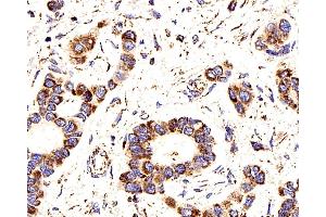 Immunohistochemistry analysis of paraffin-embedded human liver cancer using COX4I1 Polyclonal Antibody at dilution of 1:200. (COX IV 抗体)